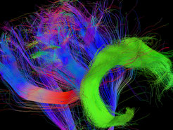 Thanks to a critical fibre connection in the brain (green) by the age of four years we suddenly start to understand what other people think.